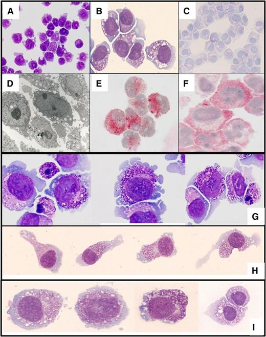 Figure 1. Phenotypic characterization of the ROSA cell lines. ROSAKIT WT cells were stained by (A-B) MGG or (C) toluidine blue. (D) The ultrastructure of ROSAKIT WT cells was analyzed by transmission electron microscopy. In addition, ROSAKIT WT cells were treated with an antibody against (E) tryptase or (F) KIT (CD117). Positivity was revealed by indirect immunocytochemistry as described in “Material and methods.” (G) Cytospin preparations or (H-I) glass smears of ROSAKIT D816V cells were stained by MGG. (G) Note the presence of many granules in ROSAKIT D816V cells and of apoptotic cells, a phenomenon likely to be related to terminal maturation induced by the introduction of the KIT D816V mutant. (H) On glass smear, a significant proportion of the ROSAKIT D816V cells presented with spindle-shaped appearance, which was not noticed for (I) ROSAKIT WT cells. Magnification: A and C, ×200; B, E, G, H, and I ×500; D, ×2000; F, ×1000.