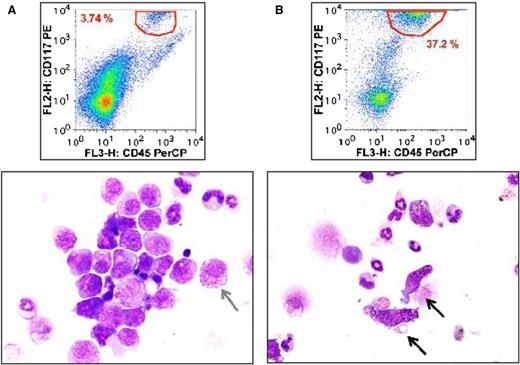 Figure 6. Morphologic appearance of BM-engrafted ROSAKIT WT and ROSAKIT D816V cells in NSG mice. Whole BM cells from NSG mice engrafted intravenously with (A) ROSAKIT WT or (B) ROSAKIT D816V cells were analyzed for their content of CD117+/CD45+ engrafted human MCs (A and B, top panels). The cells were also cytocentrifuged on glass slides, stained with MGG and then observed by using light microscopy (bottom panels). Note the presence of spindle-shaped MCs with an abnormal distribution of granules in the BM of mice engrafted with ROSAKIT D816V cells (B, black arrows), whereas the BM MCs from mice engrafted with ROSAKIT WT cells presented with a rounded shape, similar to the one observed in culture (A, gray arrows). Magnification is ×200. FL2-H, FL2 peak emission values; PerCP, peridinin chlorophyll.