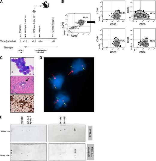 Figure 2. Functional modeling of MRD-positive ALL. (A) Schematic of the disease course and treatment from initial diagnosis of UPN 25. BM cells from the +7.8-month MRD-positive (pos) sample: 3.65 × 10−2 were transplanted into 3 individual recipient mice (8 × 10−4 nucleated cells/mouse). (B) Phenotypic characterization of BM from the single MRD engrafted recipient mouse shows CD34− xenografted leukemia; CD34+ disease was characterized at diagnosis. (C) (a) MGG staining of BM shows infiltration by monomorphic lymphoid blasts in the MRD engrafted recipient, ×60. (b) Hematoxylin and eosin–stained histological section of the liver parenchyma, ×20, and (c) human CD10 immunostaining of liver, ×20 in the MRD engrafted recipient mouse. Images were taken using Nikon Eclipse E600 microscope and Nikon DS-Fi1 camera. Black arrows indicate focal areas of leukemic infiltration. (D) FISH analysis (×100), showing presence of the original IgH@CRLF2 chromosomal rearrangement in cells harvested from BM as separated red (red arrow) and green signals (green arrow); the normal copy of the IgH gene is seen as a red-green fused signal in the same cell (yellow arrow). IgH rearrangement was detected in 97% of BM cells. (E) (Upper) Heteroduplex assessment of the original diagnostic sample from patient UPN 25 and (lower) murine BM that had engrafted with the patients MRD-ALL. MRD-ALL reproduced the identical Ig/TCR clonal rearrangements of the diagnostic sample as confirmed by sequence analysis.