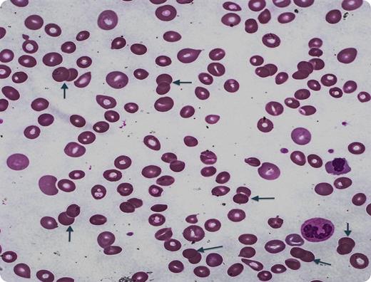 A 55-year-old woman presented with progressive fatigue, jaundice, and weight loss of 40 pounds. Physical examination revealed scleral icterus, axillary lymphadenopathy, and splenomegaly. Laboratory values showed a white blood cell count of 11 200/µL, hemoglobin 6.3 g/dL, hematocrit 18.3%, platelets 116 K/µL, haptoglobin <5.8 mg/dL, reticulocyte count 18.6%, mean corpuscular volume 131 fl, and indirect hyperbilirubinemia. Direct Coombs test was positive for immunoglobulin G (IgG) with no evidence for IgM. Peripheral smear revealed that 12% of discrete stained entities were doublets (arrows). Remarkably, there were no single spherocytes. Typically, normal smears show only rare doublets (<1%). There was no evidence of underlying lymphoproliferative disorder. Diagnosis was warm antibody autoimmune hemolytic anemia and thrombocytopenia (Evan syndrome). The patient relapsed after prednisone, rituximab, and splenectomy and eventually responded to azathioprine. With treatment, her mean corpuscular volume returned to normal along with disappearance of spherocytes. / Spherocytosis is a feature of autoimmune hemolytic anemias and results from partial phagocytosis of IgG/complement-coated erythrocytes. Doublet formation has only rarely been described previously. No triplets or larger aggregates were present is this case, but have been previously reported.