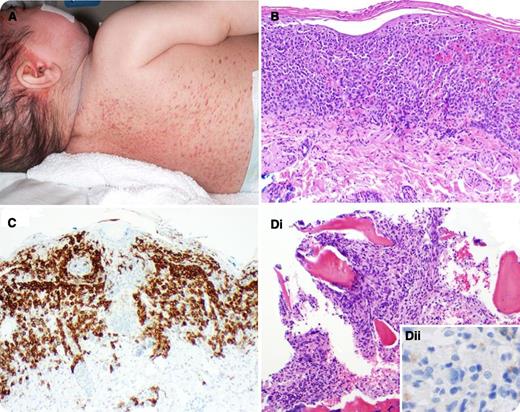 A 13-month-old boy with recurrent upper respiratory infections, persistent fevers, and chronic rash presented to our facility. The patient had been treated with several months of antibiotics and topical creams with no improvement. In the emergency room, he had a prominent rash (panel A), jaundice, and tachypnea. Complete blood count showed white blood cells 3.5 × 103/μL, absolute neutrophils 0.35 × 103/μL, hemoglobin 8.4 g/dL, and platelets 12 × 103/μL. Total bilirubin was 8.5 mg/dL. Systemic Langerhans cell histiocytosis (LCH) was suspected. Skin biopsy showed histiocytic infiltration (panel B) positive for CD1A (panel C). Bone marrow biopsy revealed presumed histiocytic infiltration (panel Di) positive for CD163 and PGM1 (CD68), but negative for CD1A (panel Dii). / Multisystemic LCH is a rapidly progressing illness in which Langerhans cells proliferate in various tissues. The hallmark is CD1A+ as seen in the skin but not in the marrow. LCH with macrophage activation in the bone marrow has been rarely described and can exist in different levels of severity. The marrow infiltrate might represent a proliferation of cells secondary to cytokine production previously reported with LCH in younger children and associated with poor prognosis. The rash of LCH is frequently misdiagnosed. Clinicians should be aware that atypical infiltrates might be activated macrophages. The skin and the marrow infiltrate have responded to chemotherapy.