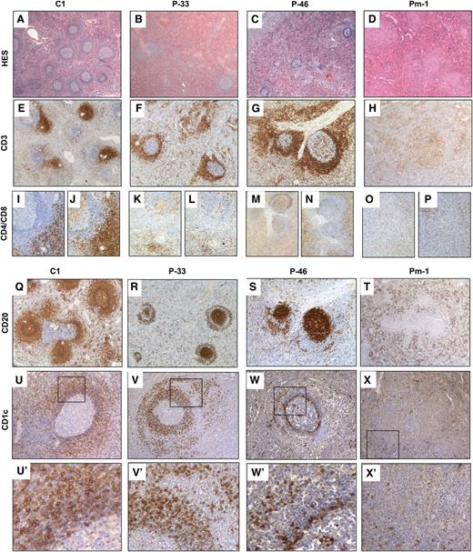 Figure 5. The architecture of the splenic white pulp is abnormal in ALPS patients. HES staining (A-D) and immunohistochemistry (IHC) (E-X) of paraffin sections of spleen specimens from control (A,E,I,J,Q,U) and from P-33 (B,F,K,L,R,V), P-46 (C,G,M,N,S,W), and Pm-1 (D,H,O,P,T,X). (A-D) HES staining revealed that patients had fewer follicles than controls (magnitude ×16). (E-H) IHC with an anti-CD3 antibody (magnitude ×25) showed normal PALSs in a control specimen (E) but revealed a striking expansion of the T-cell zone around the follicles (in place of MZ) in P-33 and P-46 (F-G). In Pm-1, nodules stained positive for CD3 (H). (K-P) As revealed by staining with specific antibodies, most of the T cells expressed neither CD4 (K,M,O) nor CD8 (L,N,P) (magnitude ×50) in ALPS patients. (Q-T) IHC with an anti-CD20 antibody (magnitude ×25) stained the follicles, mantle zone, and MZ in control spleen (Q). In P-33 and P-46, staining was positive in the follicles and the mantle zone but negative in the MZ. A ring of positive CD20+ cells (P-33) (R) or a few CD20(+) cells around the MZ were found in P-46 (S). In Pm-1, a few CD20+ cells were found in the follicle-free red pulp (T). (U-X,U’-X’) IHC with anti-CD1c antibody (U-X: magnitude ×100; U’-X’: amplification of framed area). Naïve B cells in the mantle zone are CD1c low, whereas MZ B cells are CD1c bright in control spleen (U,U’), P-33 (V,V’), P-46 (W,W’), and Pm-1 (X,X’).