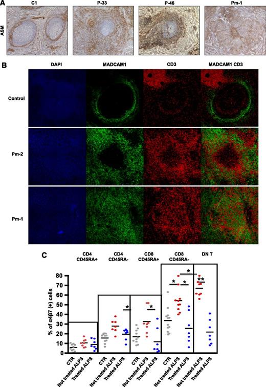 Figure 6. Extension of the MAdCAM-1(+) meshwork in ALPS spleen is associated with high expression of integrin α4β7 on DN-Ts. (A) Staining with anti-ASM antibody (magnitude ×50) on control spleen, P-33, P-46, and Pm-1 revealed a thin ring of positive cells within the MZ of control spleen. In all patients, a striking expansion of this layer was observed around the follicles in the marginal and PFZs. (B) Immunofluorescence staining with 4',6-diamidino-2-phenylindole (DAPI) (blue), anti-MAdCAM-1 antibody (green), and anti-CD3 antibody (red) in cryostat sections of a control spleen specimen (first row) and 2 ALPS spleen specimens (second and third rows). In the control spleen, staining revealed a well-delimited meshwork of MAdCAM-1(+) cells with a few CD3(+) cells inside follicles and outside the MZ. In both patient specimens, the extended MAdCAM-1(+) meshwork was in close contact with many CD3(+) cells. GC denotes germinal center. (C) The proportion of cells expressing both α4β7 integrins in various different T-cell subsets in 3 populations: healthy controls and treated and nontreated ALPS patients. DN T, double-negative T cells.
