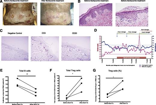 Figure 7. Treatment effects of bortezomib on clinical cGVHD human patients. A single institution pilot study of bortezomib was initiated in patients with steroid-dependent, -intolerant, or -refractory cGVHD. (A) Patient 4 showed extensive grade III skin sclerodermatous GVHD covering >0% of the body. The abdominal region before and after bortezomib treatments are shown. (B) Representative images of the pretreatment skin biopsies taken from the patient shown in A. (C) Immunohistochemical staining for CD3 and CD20 in pretreatment skin biopsy samples from patient 4. (D) CBC and biochemistry data from patient 5 were collected through the trial period. (E) Total numbers of peripheral blood B cells (CD45+CD19+) from 3 patients were analyzed by flow cytometry before and after bortezomib treatment. (F-G) Treg cell populations (CD4+CD25+Foxp3+) were analyzed by flow cytometry and shown as total numbers and percentage. All the data were collected from individual cGVHD patients that underwent bortezomib treatment. The data are shown as mean ± SEM and analyzed by Student t test to compare pre- and postbortezomib treatments. *P < .05 was considered significant.