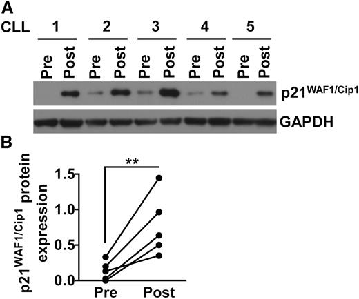 Figure 6. Lenalidomide therapy induces p21 expression in CLL cells in vivo. (A-B) CLL blood mononuclear cells from 5 different patients were collected prior therapy (Pre) and 15 days after lenalidomide treatment (Post). All patients received 2.5 mg daily for the first 7 days, and 5 mg daily for the subsequent 7 days. Protein were extracted from all samples and analyzed for p21 and GAPDH expression by immunoblot. (A) Shows the immunoblot data for all 5 patients tested. (B) Shows the densitometry analysis quantifying the expression of p21 protein in the 5 patient samples shown in (A). The expression of p21 has been normalized to GAPDH. **P < .001 (Student t test).