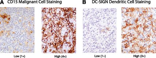 Figure 1. MGZL IHC photomicrographs. (A) CD15+ biopsies showing low (1+) and high (4+) staining of malignant cells. (B) DC-SIGN–positive biopsies showing low (1+) and high (3+) staining of infiltrating dendritic/macrophage cells.