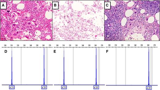 Figure 1. Analyses of CALR mutations and bone marrow morphology of the first subject. (A) Hematoxylin and eosin stain of initial marrow core biopsy and hypercellular marrow with increased megakaryocytes with variable size and shape and hyperchromatic hypolobate nuclei that are arranged in dense clustering with no overt CLL cells. (B) Reticulin stain of initial marrow biopsy with no significant increase in reticulin fibers. (C) Hematoxylin and eosin stain of follow-up marrow core biopsy after 9 years, showing megakaryocytic histotopography consistent with the prefibrotic stage of primary myelofibrosis. An increased number of small lymphocytes in aggregates are present in the upper right and lower left corners of the field, compatible with CLL (original magnification, ×40). Analysis of CALR mutations in exon 9 was performed by fragment analysis, which is a semiquantitative analysis.3 (D) Fragment analysis of CALR from granulocytes obtained 3 years after diagnosis of type 1 CALR deletion. (E) Fragment analysis data of current granulocyte DNA (9-year follow-up after diagnosis), with the same CALR deletion. (F) Fragment analysis of DNA from CD19+ cells; the type 1 CALR deletion is not present.