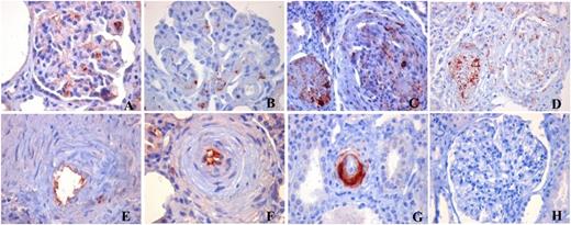 Figure 1. Immunohistochemical analysis of C3 and C9 (C5b-9) staining in kidney biopsy specimens from aHUS patients. Representative results are shown. (A) C3 deposits with main endothelial localization in a glomerulus from a patient with a CFI mutation and normal SC5b-9 plasma levels. (B) C9 staining restricted to hilar area in a glomerulus from a patient with a C3 mutation. (C) Diffuse C9 deposits in 2 glomeruli with marked ischemic injury from a patient with CFH mutation and increased SC5b-9 levels. (D) C9 deposits in glomeruli from a patient without mutations/anti-CFH antibodies. (E-F) endothelial C3 staining in arterioles from patients with CFH (E) and CFI (F) mutations. (G) Subendothelial localization of C9 staining in an arteriole from a patient with a CFH mutation and normal SC5b-9 level. (H) Control section (healthy portion of nephrectomy for cancer, C9 staining). Original magnification ×400, counterstaining with hematoxylin.