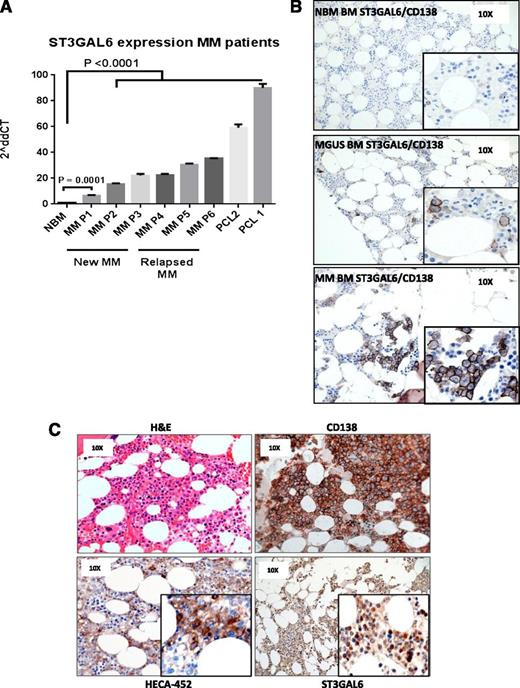 Figure 2. ST3GAL6 expression MM patients. (A) qRT-PCR demonstrating expression levels of ST3GAL6 mRNA isolated from CD138+ cells of MM patients; newly diagnosed (New MM) n = 3, relapsed MM n = 3, or plasma cell leukemia patients (PCL) n = 2 compared with CD138+ cells isolated from normal healthy bone marrow (NBM). Newly diagnosed patients had a significantly higher level of ST3GAL6 mRNA, and patients with relapsed MM and PCL demonstrated increasingly higher levels with disease progression: NBM vs P1 P = .0001, NBM vs all other patients P < .0001. (B) Immunohistochemistry (IHC): dual staining for CD138 and ST3GAL6 demonstrating minimal expression of ST3GAL6/CD138 in healthy donor bone marrow (NBM, top panel, n = 3). Positive expression of ST3GAL6 was noted in patients with MGUS (middle panel, n = 3) and in MM patients (bottom panel, n = 3). ST3GAL6 cytoplasmic brown staining, CD138 membranous dark brown/black staining, blue counterstain. (C) IHC, 4 panels from MM patient (n = 6) demonstrating: hematoxylin and eosin (top left); CD138 (top right); HECA-452 (bottom left), which recognizes sialofucosylated glycans and sialyl Lewis X (sLex); and ST3GAL6 (bottom right), demonstrating in this patient a high ST3GAL6 expression with a corresponding high expression of HECA-452.