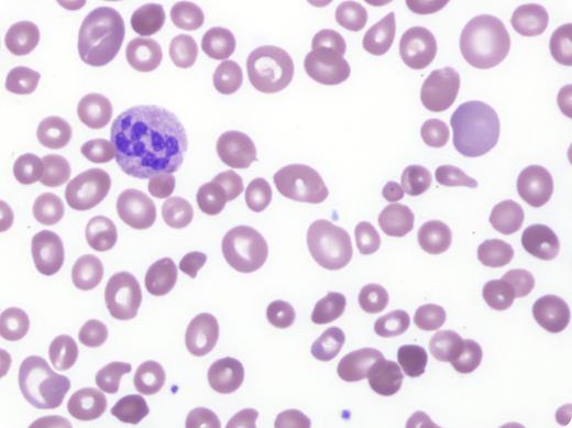 A previously healthy 43-year-old man with chronic alcoholism presented to a rural medical center with a 2-week history of confusion, fever, dyspnea, dizziness, and fatigue associated with diarrhea and hematochezia. Laboratory results were notable for a platelet count of 19 × 109/L, hemoglobin of 5.0 g/dL, hematocrit of 15.1%, white blood cell count of 3.2 × 109/L, a reticulocyte count of 5.9%, mean corpuscular volume of 118 fL, and normal creatinine. A peripheral blood smear was interpreted at the outside facility as having marked schistocytes. A diagnosis of presumed thrombotic thrombocytopenic purpura/hemolytic uremic syndrome was given. The patient was transfused with 3 units of plasma and transferred to a tertiary care hospital for therapeutic plasma exchange. A repeat peripheral blood smear showed a macrocytic anemia with increased anisopoikilocytosis, hypersegmented neutrophils, and marked thrombocytopenia consistent with megaloblastic anemia (see figure). Further testing revealed a decreased vitamin B12 level of 93 pg/mL with unremarkable iron studies. Although the patient’s profound thrombocytopenia was concerning, ADAMTS13 activity was measured at 71%, excluding thrombotic thrombocytopenic purpura. Additional workup was positive for intrinsic factor antibodies, confirming the diagnosis of pernicious anemia. / Although the clinical presentation and degree of thrombocytopenia may be concerning for a microangiopathic process, careful review of the peripheral blood will help direct appropriate clinical management. Severe megaloblastic anemia may cause marked anisopoikilocytosis with bizarre microcytes and thrombocytopenia. These findings should not be confused with microangiopathic hemolytic anemia.