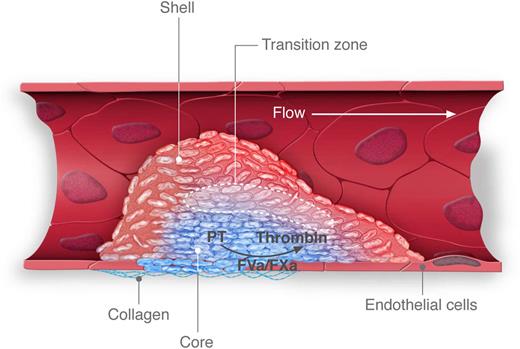 Thrombus formation following penetrating injury. In this depiction of thrombus formation induced by laser or sharpened glass probe, injury results in the exposure of phosphatidylserine on the endothelial cell surface and initiates assembly of the prothrombinase complex. A core of tightly packed platelets (blue) forms at the injury site and restricts the transport of agonists, including thrombin. A shell of loosely adherent, unactivated platelets (red) forms around the core. The core expands over time as agonists diffuse out of the core into the shell, creating a transition zone (dotted lines) in which activation of loosely adherent platelets occurs. Professional illustration by Luk Cox, Somersault1824.