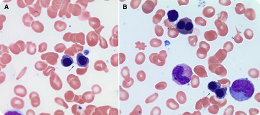 A 68-year-old woman with rheumatoid arthritis controlled with methotrexate, meloxicam, and prednisone was found to have chronic anemia and thrombocytopenia. Her complete blood count panel showed a white blood cell level of 4.8 × 109/L, neutrophils 2.2 × 109/L, hemoglobin 106 g/L, mean corpuscular volume 95.5 fL, and platelet count 45 × 109/L. Her bone marrow analysis revealed dysplastic features in all lineages with <3% blasts. The erythroid precursors in particular showed binucleate forms, some with chromatin bridging (panels A-B) and nuclear budding. These findings are in keeping with an underlying diagnosis of myelodysplastic syndrome (MDS). / Internuclear chromatin bridging is a fine or coarse band of nuclear material connecting 2 nuclei. It is a relatively uncommon morphologic finding not associated with normal marrow and is a sign of impaired mitosis that results from failure of sister chromatids to separate during cell division. This phenomenon can be seen in all subtypes of MDS. Although chromatin bridging is characteristic of the rare condition congenital dyserythropoietic anemia type 1 in an elderly patient, it may suggest MDS. Further, internuclear chromatin bridging may contribute to the addition and deletion of genetic material, which is often a feature of MDS.