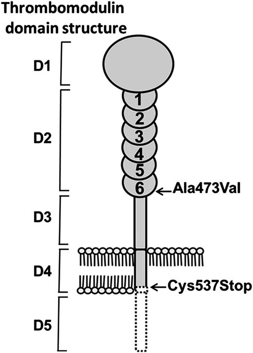 Figure 4. The predicted structural consequences of TM Cys537Stop mutation. The TM domains shown are: D1 = lectin; D2 = EGF-like; D3 = O-glycosylation; D4 = transmembrane; and D5 = cytoplasmic. The Ala473Val mutation in EGF6 was present only in the propositus. The Cys537Stop mutation was present in all 3 family members and resulted in loss of the C-terminal portion of the transmembrane helix and the entire cytoplasmic domain (dotted black line). The consequence of the introduction of a negatively charged C-terminus into the hydrophobic lipid bilayer, together with the loss of stabilizing protein interactions with cytoplasmic domain, resulted in the shedding of TM into the blood plasma.
