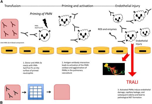 Figure 1. Anti-HNA-3a induced TRALI and the effect of filtration on TRALI. (A) Anti-HNA-3a induced TRALI. Antibodies to HNA-3a are postulated to bind to primed neutrophils expressing HNA-3a, leading to activation, agglutination, and subsequent pulmonary injury resulting in TRALI. First, anti-HNA-3a in the blood component binds to human neutrophils expressing HNA-3a/CTL2-P1. Next, antibody-antigen interactions lead to agglutination of neutrophils and activation of the PMN oxidase. Then activated PMNs release ROS and enzymes that mediate endothelial damage, vascular compromise, and edema, subsequently leading to TRALI. NETs are postulated to form as a pathological bioproduct of neutrophil activation, leading to further endothelial injury. (B) Effect of filtration on TRALI. Modified and experimental Pall BPF4 leukoreduction filters deplete blood products of anti-HNA-3a among other antibodies. Reduction of TRALI-inducing substances in the blood component can result in decreased subsequent lung injury, as a potential preventative mechanism.
