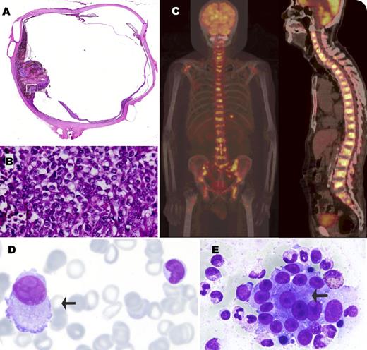 A 76-year-old man received left eye enucleation resulting from ablepsia in May 2013. A pathological review suggested a malignant melanoma of the choroid body with staging of T2b (panel A); white quadrangle in A, original magnification, ×200 (panel B). The patient visited an oncology outpatient department for persistent low back pain and asthenia for more than 1 month in September 2013. For malignant melanoma surveillance, unexpectedly, a whole-body 18F-fluorodeoxyglucose-positron emission tomography revealed increased 18F-fluorodeoxyglucose uptake over the whole cervical-thoracic-lumbar spine, sacrum, pelvic bone, bilateral proximal femoral bone, and bilateral scapular bone (panel C). Liu’s stain of a peripheral blood smear revealed leukoerythroblastosis and circulating tumor cells with abundant cytoplasm and bizarre nucleus (panel D, arrow). Bone marrow study demonstrated nonhematopoietic cells with prominent nucleus arranged in clusters (panel E, arrow). Immunohistochemical analysis was positive for S-100 and human melanoma black 45, thus identified as metastatic melanoma. After confirmed diagnosis, the patient died of respiratory failure secondary to pneumonia 2 months later. / Uveal melanoma with bone marrow involvement is very rare. However, similar clinical pictures have been reported in patients with cutaneous melanoma. An interesting finding of this case is the presentation as hematologic malignancy in positron emission tomography scan and blood smear.