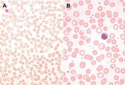 A 35-year-old white woman was found to have persistently high platelet counts of >600 × 109/L for nearly 2 years. Her hemoglobin, mean corpuscular volume and white cell counts were normal. Blood film showed morphological abnormalities in red cells with plenty of acanthocytes, spiculated spherocytes, target cells, spherocytes, stomatocytes, and Howell-Jolly bodies. Platelet anisocytosis and giant platelets were also noted in the blood film (panels A and B). These blood film changes are commonly seen in hyposplenism, which can occur in the congenital absence of spleen, sickle cell disease, celiac disease, vasculitis, ulcerative colitis, essential thrombocythemia, and after splenectomy. This patient did not undergo splenectomy, but she had celiac disease and did not adhere to gluten-free dietary restrictions. Ultrasonography showed a normal-sized spleen, but a radionuclide liver-spleen scan revealed no splenic uptake. These findings were consistent with functional hyposplenism, which was deemed to be secondary to celiac disease. Bone marrow biopsy and JAK2-V617F and BCR-ABL mutation tests performed for evaluation of persistent thrombocytosis excluded a myeloproliferative neoplasm, thus confirming hyposplenism-associated thrombocytosis. / The exact mechanism of hyposplenism in celiac disease is unclear. Life-threatening bacterial infections with pneumococci, meningococci, Haemophilus, and Capnocytophaga canimorsus can occur in patients with hyposplenism. The patient was counseled about hyposplenism, and pneumococcal, meningococcal, and Haemophilus influenzae type b vaccinations were administered.