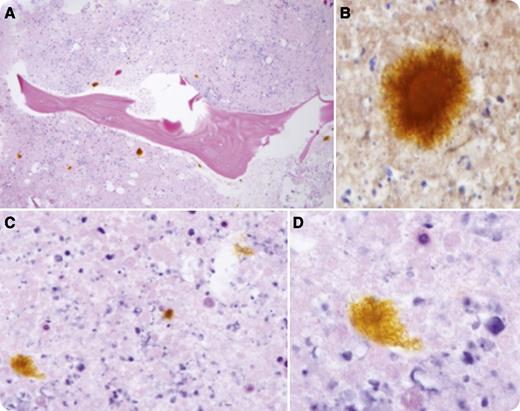 A 53-year-old man with a 3-month history of anemia and thrombocytopenia was admitted for acute gastrointestinal bleeding. Peripheral blood counts demonstrated leukocytosis (18.6 × 103/μL), anemia (hemoglobin level, 8.7 g/dL; hematocrit, 27%), and thrombocytopenia (53 × 103/μL). Prior marrow biopsy demonstrated marrow necrosis, precluding definitive diagnosis. Scattered throughout the necrotic milieu were numerous amber filamentous structures whose pigment was maintained through a range of histochemical stains, such as hematoxylin and eosin, Prussian blue, Gram, and trichrome. Panel A shows a scanning hematoxylin and eosin slide with hematoidin pigment in the marrow space. Panels B-D show details showing the necrotic bone marrow space and magnified views of the hematoidin crystal. Follow-up enteroscopy and biopsy revealed a primary intestinal adenocarcinoma. / Hematoidin has a golden-brown crystalline pigmentation and is composed of thread-like filaments arranged in star-shaped clusters akin to a Medusa’s head. Hematoidin forms when erythrocyte extravasation occurs in a closed tissue compartment and is a result of hemoglobin metabolism under low oxygen tension conditions. Following erythrocyte degeneration, porphyrin is released from hemoglobin and is converted to biliverdin, which is reduced to crystalline hematoidin. Because hematoidin can be converted back to biliverdin, it is not always seen. This may explain its rarity. Recognizing hematoidin and its morphologic features can circumvent unnecessary analysis.
