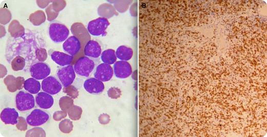 A 71-year-old man presented with pallor and generalized lymphadenopathy. The complete blood count showed a hemoglobin level of 9.4 g/dL; total leukocyte count of 64 000/μL with 78% blasts; and a platelet count of 86 000/μL. The peripheral blood smear showed large blasts with dispersed nuclear chromatin and multiple prominent nucleoli with agranular, mildly basophilic, scanty cytoplasm (panel A). The blasts were myeloperoxidase negative. On flow cytometry, the side scatter (SSC)/CD45 gated cell cluster was negative for CD34, CD13, CD33, CD117, CD14, CD3, and CD7, but positive for CD5, CD19 (bright), and CD22. Further flow cytometry, gated on SSC/CD19, showed strong positivity for CD5, CD22, and κ light chain, but negative for CD23, cyclin D1, or λ light chain. Immunostaining of the bone marrow sections showed diffuse infiltration of CD20-positive cells (panel B). The final diagnosis was made as CD5+ diffuse large B-cell lymphoma in the leukemic phase. The lymph node histopathology report was consistent as well. / An acute leukemia panel devoid of light chain surface immunoglobulins may culminate in the wrong diagnosis, particularly with blastic cell morphology. In this case, the first flow cytometry was suggestive of B-lymphoblastic leukemia, consistent with the morphology. Inclusion of light chain surface immunoglobulins in the acute leukemia panel is thus highly recommended.