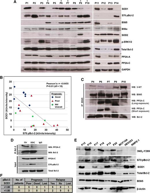 Figure 6. In vivo evidence of an inverse relationship between SOD1 expression and the level of both S70pBcl-2 and B56δ tyrosine nitration. (A) Western blot (WB) analysis of clinical lymphoma biopsies that are arbitrarily numbered as P1-P14. More complete clinical diagnoses for these samples are described in supplemental Figure 7. Lymphoma biopsies denoted with an asterisk were derived from tumors sufficiently large for further analysis via co-IP assay. (B) Scatter plot analysis of densitometry intensity values of SOD1 and S70pBcl-2. Densitometry values of each sample can be found in supplemental Figure 7. Statistical significance was calculated using Pearson correlation coefficient with a degree of freedom of 18. (C) B56δ was IP from lysates denoted with asterisk and IB for the indicated proteins. (D) This experiment was performed using a rare, huge mantle cell lymphoma that could be sufficiently separated into 3 samples for co-IP analysis. Single cell suspension was prepared, treated for 4 hours with 400 μM DDC, and then harvested for co-IP assay using the indicated Abs. (E) WB analysis of 6 other clinical lymphoma biopsies denoted as P15-P20 with 3 other nonmalignant cell lines: MCF10A breast epithelial cells, HEK293 human embryonic kidney cells, and RWPE-1 prostate epithelial cells. (F) The ratio of S70pBcl-2:SOD1 was calculated using the densitometry value of each protein in supplemental Figure 7 and subsequently correlated with the prognosis or relapse status of each tumor. A ratio greater than 1 would mean a greater abundance of S70pBcl-2 relative to SOD1 and vice versa. Prognosis records, clinical data, and diagnosis of all primary samples can be found in supplemental Figure 7. Three samples—P9, P13, and P20—were diagnosed as reactive lymphoid hyperplasia (not lymphomas) and therefore excluded from the analysis. Clinical records for some patients were unavailable or lost because of a loss of follow-up or some biopsies may have been donated by overseas patients and could not be retrieved.