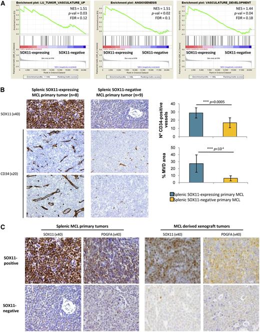 Figure 5. SOX11-positive MCL tumors have increased tumor angiogenesis network and PDGFA overexpression. (A) GSEA analysis on expression data sets from leukemic MCL primary tumors (16 SOX11-expressing and 22 SOX11-negative (GSE36000)17 showing enriched gene sets related to angiogenesis pathways. NES, P-val, and FDR are shown. Statistical significance is considered when FDR < 0.2. (B) Left panel, Histological sections from representative SOX11-expresing (n = 8) and SOX11-negative (n = 9) splenic MCL primary tumors stained with specific antibodies against human SOX11 (×40) and CD34 (×20). Right panel, Graph showing quantification of number of CD34-positive vessels and percentage of CD34-positive MVD areas of the splenic MCL primary tumors. Bar plot represents the mean percentage ± SD. P-val are shown. The significance of difference was determined by independent samples t test. (C) Representative histological sections from SOX11-positive and SOX11-negative tumors from splenic MCL primary samples (n = 8 and n = 9, respectively) and MCL xenograft tumors (n = 3 and n = 10, respectively) stained with a specific antibody anti-human SOX11 (×40) and PDGFA (×40).