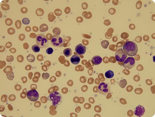 A 3-year-old boy with sickle cell disease (SCD) presented to the emergency room postsplenectomy for abdominal pain and constipation. Upon examination, he was noted to be tachycardic with a 3/6 systolic ejection murmur. Complete blood count showed a white blood cell (WBC) count of 62.3 × 109/L, hemoglobin 50 g/L, platelets 586 × 109/L, mean corpuscular volume 84.3 fL, and 111 nucleated red blood cells (RBCs) per 100 WBCs. Morphologic examination of the peripheral blood showed a leukoerythroblastic smear, including rare blasts and erythroid mitotic figures, and thrombocytosis, including occasional large platelets. Lactate dehydrogenase was 981 U/L and uric acid was 4.7 mg/dL. Given these findings, there was concern for a myeloproliferative neoplasm (MPN), although MPNs are not known to be associated with SCD. However, within 24 hours, his WBC count decreased to 30.7 × 109/L, and his parvovirus polymerase chain reaction was reported as positive. Following transfusion with 10 mL/kg packed RBCs, his tachycardia and abdominal pain resolved, and no further interventions were employed. Within 1 week, his WBC count had normalized to 9.4 × 109/L. / Leukoerythroblastosis that mimics juvenile myelomonocytic leukemia has been reported in neonates with Epstein-Barr virus and cytomegalovirus infections. However, this case of extreme leukocytosis represents an unusual and rarely reported presentation of parvovirus infection in a splenectomized toddler.