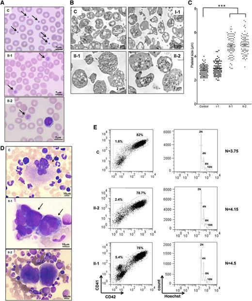 Figure 2. Platelet and MK analysis. (A) Cytological investigation of blood platelets. The black arrows point to platelets in the blood smears. Note the much larger platelet size for patients (II-1 and II-2) compared with control (C). (B) Ultrastructural aspect of blood platelets. Large platelets were detected in blood of II-1 and II-2 patients, and platelets of normal size were detected in 1 control and in a I-1 family member with the heterozygous PRKACG mutation. (C) The size of 100 platelets for control, I-1, II-1, and II-2 individuals was measured. The results represent mean ± SEM. ***P < .0001, unpaired Student t test (2-tailed). (D) Cytological investigations of the bone marrow of II-1 and II-2 patients and control. (E) MK differentiation was induced from control or patient peripheral blood CD34+ cells and analyzed at day 10 of culture. Gates represent mature (CD41+CD42+) or immature (CD41+CD42−) MKs (left). The ploidy level (N) was analyzed in the gate of CD41+CD42+ MKs and was based on the percentage of cells in 8N, 16N, and 32N gates.