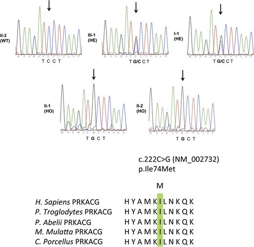 Figure 4. Germ-line PRKACG mutation. Electrophoregram of PRKACG gene (NM_00273), as sequenced by the Sanger method, revealed no mutation in individual II-3 designed as wild type (WT). Individuals III-1 and I-1 were found to be heterozygous (HE) for the c.222C>G mutation, without clinical features of macrothrombocytopenia. Patients II-1 and II-2 were found to be homozygous for the c.222C>G mutation and exhibited macrothrombocytopenia. The c.222C>G mutation caused substitution of the evolutionarily conserved Ile amino acid. Homologous sequences were aligned using the CLUSTALW Web site.