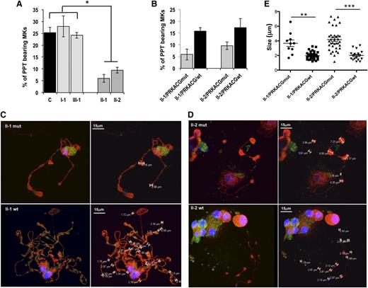 Figure 6. Mutant PRKACG leads to defective PPT formation, which is rescued by wild-type PRKACG overexpression. (A-E) In vitro MK differentiation was induced from control or patient peripheral blood CD34+ progenitors in the presence of TPO and SCF. (B-E) CD34+ cells of patients II-1 and II-2 were transduced with a lentiviral vector harboring wild-type (wt) or mutant PRKACG cDNA (used as a control of experiment) at days 1 and 2 of culture. (A-B) The percentage of PPT-forming MKs was estimated by counting MKs exhibiting ≥1 cytoplasmic processes with areas of constriction at day 13 of culture. A total of 200 cells per well were counted. The histograms show 1 of 2 independent experiments with similar results. Each experiment was performed in triplicate. Data represent mean ± SD of triplicate. *P < .05, 2-tailed Mann-Whitney test. (C-D) Immunoconfocal analysis of platelet-like structures formed by PPTs generated from patients (C) II-1 and (D) II-2. MKs overexpressing wt or mutant PRKACG PPT-forming MKs were allowed to adhere on fibrinogen for 2 hours at day 13 of culture and stained with anti-tubulin (red) and rabbit anti-VWF (green) antibodies. Confocal imaging was performed on a Leica TCS SP8 inverted laser scanning confocal microscope (Leica Microsystems, Heidelberg, Germany), equipped with a 405-nm UV laser diode and visible optically pumped semiconductor lasers (488 and 552 nm). All images were acquired using an oil immersion 63× objective (1.4 numeric aperture). (E) At least 5 MKs for each condition were analyzed, and the size of platelet-like structures was measured by LAS AF version 2.4.1 software. Data are presented ± SEM. **P < .005 and ***P < .0001, unpaired Student t test with Welch’s correction.