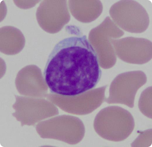 The patient is a 92-year-old woman who presented to the hematology clinic 3 years earlier for evaluation of persistent lymphocytosis. At that time, her white blood cell count was 15 200/µL, hemoglobin was 12.8 g/dL, and platelets were 245 000/µL. Her absolute lymphocyte count was 7870/µL. She did not have lymphadenopathy or hepatosplenomegaly on physical examination. Flow cytometry was performed and revealed a monoclonal B-cell proliferation that was CD5 and CD10 negative. Fluorescence in situ hybridization testing for t(11;14) and rearrangements/additions of chromosomes 11q, 12, 13q, and 17p13.1 were negative. The monoclonal lymphocytosis was monitored with serial surveillance. At the most recent clinic visit, her absolute lymphocyte count was 21 310/µL, and morphologic examination of the peripheral smear revealed mononuclear cells with Auer rod–like cytoplasmic inclusions. Flow cytometry redemonstrated the monoclonal B-cell proliferation, without any evidence of myeloid differentiation. A cytochemical stain for myeloperoxidase was negative. / This case highlights a rare example where the presence of Auer rod–like inclusions does not automatically denote myeloid differentiation. To the best of our knowledge, the presence of Auer rod–like lymphocyte inclusions has been previously reported only in a single case of a peripheralizing marginal zone lymphoma from Japan.