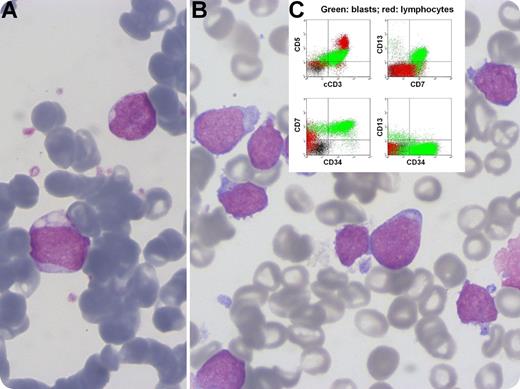 A 63-year-old man presented with an enlarged left cervical lymph node. Complete blood count showed hemoglobin 14.3 g/L, mean corpuscular volume 101 fL, white blood cells 3.26 × 109/L, absolute neutrophil count 1.87 × 109/L, and platelets 90 × 109/L. Ten years ago, he was diagnosed with acute myeloid leukemia subtype M1 with a normal karyotype. At that time, blasts had a medium to high nuclear:cytoplasmic (N:C) ratio, irregular nuclei, and sporadic vacuolation (panel A). He initially achieved complete response (CR) with cytarabine plus idarubicin (7 + 3 regimen), relapsed at 6 months, and reattained CR with salvage regimens plus gemtuzumab ozogamicin. Marrow aspirate now revealed small and medium-size blasts with a high N:C ratio, cytoplasmic blebs, and round nuclei with conspicuous nucleoli and frequent hand-mirror configuration (panel B). Immunophenotypically blasts were CD34+, CD7+, cytoplasmic CD3+, CD5+, CD13+, and CD1a– (panel C), and lymph node biopsy demonstrated complete architectural effacement by a diffuse infiltrate of large and medium-size blasts expressing CD3, CD10, CD7, and CD99, which established the diagnosis of precursor T-cell acute lymphoblastic leukemia/lymphoma. Two distinct clones were identified by conventional karyotyping, one bearing the interstitial deletion del(11)(q14q22) and the other bearing trisomy 21. / This very rare case of leukemia reemergence after a 10-year remission illustrates the complex pathobiology of leukemogenesis and underscores the importance of immunophenotyping when morphology is not unambiguous.