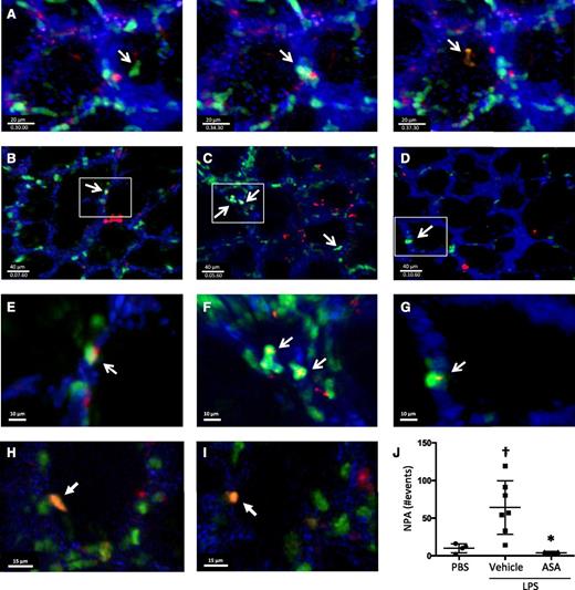 Figure 3. Lung intravital microscopy reveals the dynamic formation of NPAs in the lungs under homeostatic and injury conditions. (A) Screenshots of a PF4-cre × Rosa26-LSL-tdTomato × LysM-eGFP mouse under basal conditions showing the dynamic formation of NPAs in the lung microcirculation (supplemental Movie 1). (B-G) Screenshots with zoom insets of PF4-cre × Rosa26-LSL-tdTomato × LysM-eGFP mice challenged intratracheally with (B,E) PBS, (C,F) LPS + vehicle, or (D,G) LPS + ASA and imaged directly after challenge (supplemental Movies 2-8). White arrows indicate NPAs. (H-I) Screenshots from PF4-cre × Rosa26-LSL-tdTomato × LysM-eGFP mice challenged with intratracheally LPS and imaged 24 hours after instillation. White arrows indicate intra-alveolar NPA (supplemental Movie 9). (J) Quantification of NPAs in B-D. †P < .05 vs PBS; *P < .05 vs vehicle. Data are mean ± SD of 3 to 7 animals per group.