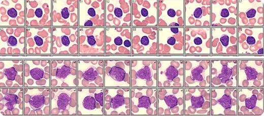 A 77-year-old woman presented with cervical adenopathy. A complete blood count was performed: white blood cells (WBCs), 13.8 × 109/L; absolute lymphocytes, 11.9 × 109/L; hemoglobin, 12.4 g/dL; and platelets, 199 × 109/L. Immunophenotyping of peripheral blood confirmed a diagnosis of chronic lymphocytic leukemia (CLL). Lymphocytes were CD5+, CD19+, CD23+, CD79B+, FMC7−, CD38+, and ZAP70+. Cytogenetics/molecular analysis revealed trisomy 12 and unmutated immunoglobulin heavy chain variable region (IgVH). Positron emission tomography computed tomography showed splenomegaly and widespread adenopathy. WBC differential by digital microscopy (Cellavision) revealed 9% neutrophils, 3% eosinophils, 2% monocytes, 60% lymphocytes, and 26% large abnormal lymphoid cells with clefted nuclei, moderately clumped chromatin, and pale blue cytoplasm. These findings were consistent with French-American-British atypical CLL (aCLL), mixed cell type. Although the possibility of Richter’s transformation could not be ruled out, clinical, laboratory, and radiologic findings did not support this diagnosis (data not shown). / Patients with aCLL may experience more aggressive disease and shortened survival. Also, as was seen in this case, aCLL has been associated with poor prognostic indicators such as unmutated IgVH, CD38+, ZAP70+, and trisomy 12. Digital microscopy is a rapid and inexpensive screening tool that improves the ability to identify aCLL patients. An experienced morphologist can quickly compare/contrast and classify variant lymphocytes as they are presented on a wide-screen monitor. The images are archived for a second review if needed and comparison with previous or subsequent results.