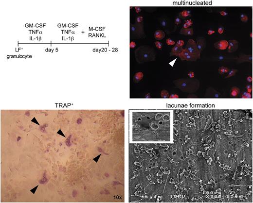Figure 6. Neutrophils from G-CSF–mobilized blood can be induced to acquire osteoclast phenotype. Neutrophils from G-CSF–mobilized donors were stimulated with GM-CSF (10 ng/mL)/TNFα (25 ng/mL)/IL-1β (10 ng/mL) for 5 days, followed by a culture period in osteoclast-promoting conditions (M-CSF, 25 ng/mL; RANKL, 100 ng/mL). TRAP (lower left; original magnification ×10) and immunofluorescence (upper right; nuclei, blue; actin, red; original magnification ×40) at day 21 of osteoclast culture identify cells with osteoclast phenotype (arrowheads). Lower right: Secondary cultures were initiated on bovine bone discs, and lacunae formation was assessed by scanning electron microscopy (bar = 100 µm). The insert shows a single osteoclast (bar = 10 µm) with several lacunae in its surrounding area. Data are representative of 3 experiments.