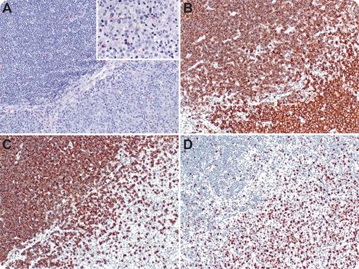A 65-year-old woman with a 3-year history of chronic lymphocytic leukemia (CLL) presented with rapidly progressing lymphadenopathy without lymphocytosis over the course of 2 months. Positron emission tomography-computed tomography scans showed hypermetabolism in the neck, axilla, and subpectoral regions and mediastinum with standardized uptake values ranging from 2 to 6. The patient underwent mediastinoscopy and biopsy. The specimen demonstrated sheets of large cells (70%) segregated from areas of small cell lymphoma/CLL (30%). Panel A shows distinct demarcation between CLL (top) and diffuse large B-cell lymphoma (bottom); inset shows large cells in detail. The small cells exhibited weak staining for CD20, as expected for CLL, compared with the population of large cells (panel B). The transformed population of large cells demonstrated loss of CD5 (panel C) and gain of C-MYC (panel D). By B-cell gene rearrangement, this tumor was identical to the patient’s prior biopsy. Diagnosis was diffuse large B-cell lymphoma, arising from CLL/small lymphocytic lymphoma (SLL) (Richter’s transformation). / Pathologic diagnosis of Richter’s transformation typically shows isolated large cell lymphoma in a patient with known history of CLL/SLL. This case demonstrates the coexistence of the small and large cell components, classic immunophenotypic alterations, and evidence of amplification of a strong proto-oncogene. C-MYC abnormalities are one of the most frequent genetic lesions in Richter’s syndrome, often acquired at transformation.