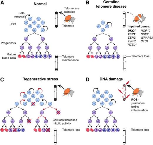 Figure 1. Mechanisms of telomere attrition. (A) Physiological telomere attrition in normal individual hematopoietic cells is the result of balance between telomerase mediated telomere elongation and telomere loss with each cell division. Gradual decrease in mean telomere content occurs with age. (B) Germ-line mutations in a telomere repair gene lead to a reduced stem cell pool and severe telomere loss during replication. (C) Regenerative replicative stress during bone marrow failure, recovery after chemotherapy, or hematopoietic transplant also leads to telomere loss due to increased mitotic activity in stem cells and/or progenitors. (D) Reactive oxygen species (generated from radiation, toxins, and inflammation) cause DNA damage and telomere loss as a direct effect on the telomere. HSC, hematopoietic stem cell.