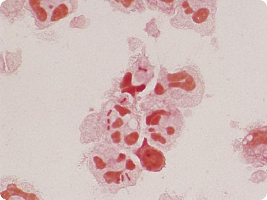 A 36-year-old woman was diagnosed with a sellar-suprasellar craniopharyngioma and underwent transsphenoidal resection of the tumor. A lumbar drain was placed to minimize intracranial pressure and was removed on postoperative day 6. On postoperative day 9, the patient began to leak cerebrospinal fluid (CSF) from her right nostril. A second lumbar drain was placed. One day later, the patient developed a fever and headache with nuchal rigidity. CSF was withdrawn from the lumbar drain and sent to the microbiology laboratory for Gram stain and culture and to chemistry for cell counts. Cell counts were as follows: nucleated cells, 60 000 (normal 0-5); cells counted, 100; neutrophils, 95% (normal 0% to 6%); lymphocytes, 2% (normal 40% to 80%); macrophages, 3% (normal 15% to 45%). Glucose was reduced (3 mg/dL), and protein was elevated (>300 mg/dL). Gram stain of cytospin-concentrated CSF showed many neutrophils and intracellular gram-negative rods with bipolar staining. The organism was identified as Enterobacter aerogenes. / Bipolar staining is typically described as characteristic of Yersinia pestis; however, it is important to note that most Enterobacteriaceae can have a bipolar staining appearance when found in clinical specimens. The patient improved clinically on empiric therapy with vancomycin and ceftazidime, and she was switched to meropenem.