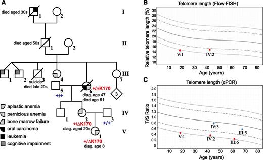 Figure 1. ACD/TPP1 mutation and telomere length in family with history of anemia and cancer. (A) Pedigree and clinical diagnoses of family. The genotypes of the proband and 4 of her family members are shown (+/+ for homozygous WT and +/ΔK170 for heterozygous deletion). Numbering of individuals corresponds with numbering in supplemental Table 1. (B-C) Telomere lengths of 5 family members were measured by Flow-FISH (B) or qPCR (C). Red symbols indicate individuals with the ΔK170 mutation, and blue symbols indicate WT individuals. Curves represent the 1st, 10th, 50th, 90th, and 99th percentiles of telomere lengths in ∼240 healthy individuals. diag., diagnosed.