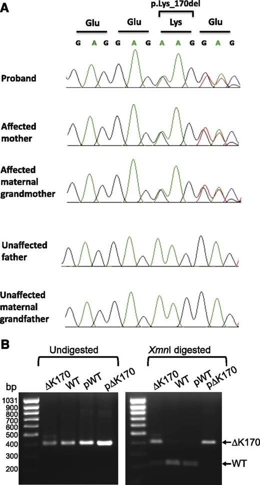 Figure 2. Genomic sequencing and mRNA expression of the ΔK170 mutant allele. (A) Sanger sequencing validates segregation with disease of a 3-bp deletion in the ACD gene, encoding the protein TPP1. The deletion (c.499_501del; p.Lys170del) was detected in the proband, mother, and maternal grandmother. The deletion was not present in the father and maternal grandfather. (B) RT-PCR of a 400-bp region across the ΔK170 region of TPP1 (left). RNA was isolated from fibroblasts of the proband (ΔK170) and the cell line HCT116 as a positive control for WT TPP1 expression (WT). Plasmids encoding WT or ΔK170 TPP1 sequence (pWT and pΔK170) were amplified as positive controls. XmnI digestion of the PCR products from the left panel (right). WT sequence is digested into 2 pieces of 212 and 188 bp, whereas the ΔK170 sequence remains uncut.