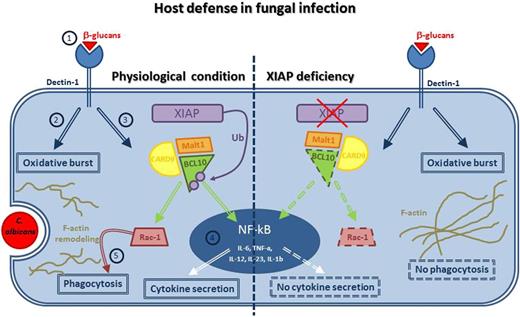 In physiological conditions, engagement of dectin-1 by β-glucans composing the fungi wall (1) triggers a complex signaling pathway mediating the oxidative burst (2) and the CARD9/BCL10/Malt1 complex formation (3), which in turn activates NF-κB, with secretion of proinflammatory cytokines (4), and Rac-1, inducing F-actin remodeling and mediating phagocytosis (5). Collectively, these processes lead to the pathogen clearance and consequently to the switching off of the inflammatory burst. In XIAP deficiency, dectin-1–induced innate responses is impaired. BCL10 fails to activate on one side, NF-κB, resulting in no secretion of NF-κB–mediated proinflammatory cytokines, and on the other side, Rac-1, resulting in no phagocytosis. Persistence of C albicans results in overactivation of macrophages, excess production of inflammatory cytokines, and hemophagocytic syndrome. Dashed lines represent the inactive molecules/processes of the pathway.