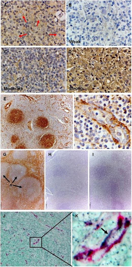 Figure 4. Both LTα-expressing HRS cells and enhanced hyaluronan expression are detected in cHL lymph nodes. (A) Expression of LTα could be detected in HRS cells (red arrows) and in the stroma of cHL lymph node sections by IHC. The overall LTα staining intensity was categorized as (B) weak/negligible, (C) moderate, and (D) strong as indicated. (E) Labeling by HABP shows positive staining localized to the germinal centers of B-cell follicles and vascular structures in reactive lymph nodes. (F) Strong subendothelial positivity and punctuate luminal staining are seen in the HEV. (G) Intense HABP labeling is seen in the stroma with weaker intensity detected in the nodules (n) in cHL tissue. (H) Treatment of the tissue section with hyaluronidase completely abrogated HABP staining. (I) cHL section incubated with purified mouse IgG as primary Ab serves as the negative control. (J-K) Double-staining with anti-CD31 mAb and HABP confirms the expression of hyaluronan on endothelial cells in cHL section. Images shown are representative cases from 32 cHL cases for A-D; a representative sample from 10 reactive lymph nodes screened for E-F; a representative case from 10 cHL cases for G-I; and a representative of 10 cHL cases that were doubled-stained with anti-CD31 and HABP for J-K. IHC images were acquired using an Olympus BX43 microscope equipped with the Olympus DP72 camera at the following original magnifications: ×100 objective for A-D, F, and K; ×10 objective for E and G-I; and ×40 objective for J.