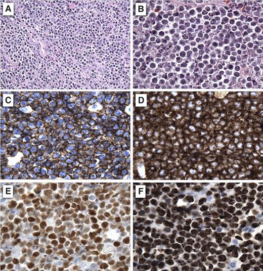 Figure 1. Histopathology of BL. Low-power (A) and high-power (B) field hematoxylin and eosin stain; CD20 (C), CD10 (D), MYC (E), and Ki67 (F) immunostains. Illustration by Scott Rodig, Brigham and Women’s Hospital, Harvard Medical School.