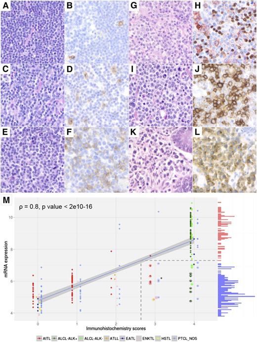 Figure 1. Correlation between CD30 mRNA and protein expression by tumor cells assessed by IHC in 238 PTCLs. Representative examples of the CD30 expression scores in PTCLs (A,C,E,G,I,K: hematoxylin and eosin; B,D,F,J,L: CD30 immunostaining by immunoperoxidase; H: double CD30/PAX5 immunostaining by immunoperoxidase, 3-amino-9-ethyl carbazole for CD30, and 3,3′ diaminobenzidine for PAX5, respectively; magnification ×40). (A-B) PTCL-NOS composed of small tumor cells with CD30 immunohistochemical score 0 (rare CD30+ cells, <5%). (C-D) PTCL-NOS composed of small/medium atypical cells with CD30 immunohistochemical score 1 (scattered tumor cells express CD30). (E-F) PTCL-NOS composed of medium/large tumor cells with immunohistochemical score 2. (G-H) AITL featuring a CD30 immunohistochemical score 2 (the CD30+ cells mainly correspond to CD30+/PAX5− tumor cells, in addition to scattered CD30+/PAX5+ B blasts). (I-J) PTCL-NOS composed of medium/large tumor cells with CD30 immunohistochemical score 3. (K-L) EATL type 1 composed of large tumor cells with CD30 immunohistochemical score 4. Correlation between CD30 IHC scores and CD30 mRNA expression levels (M; histogram shown on the y-axis, red bars = high expression; blue bars = low expression). The regression line between mRNA and protein expression values is shown (blue); this line is used to project the mRNA expression value that distinguishes high- from low-CD30–expressing samples onto its corresponding IHC level (broken lines). Samples that express low levels of CD30 mRNA but that have high IHC scores are shown with a halo. Asterisks indicate points where 2 samples overlap.