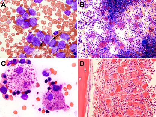 A 16-year-old Hispanic girl presented to our hospital after a 3-week history of bruising and gingival bleeding. She was found to be pancytopenic and diagnosed with acute promyelocytic leukemia (APL), with cytogenetics, fluorescence in situ hybridization, and reverse-transcriptase polymerase chain reaction confirming t(15;17)(q24;q21) and PML-RARA fusion. The initial bone marrow aspirate is depicted in the figure (panel A), with arrows indicating the cells with Auer rods. Chemotherapy with all-trans retinoic acid and arsenic trioxide was commenced and, before the end of induction, no abnormal promyelocytes or Auer rods within more mature cells in the neutrophil series could be identified in the peripheral blood. Bone marrow examination upon count recovery revealed hematologic remission. However, abundant phagocytic histiocytes were present, containing crystals (possibly representing Auer rods), granules, and globules, which appeared fuchsia on Wright-Giemsa stain (panels B-C), were eosinophilic with hematoxylin and eosin stain (panel D), and were strongly positive for CD68 and myeloperoxidase, the latter by enzyme cytochemistry and immunhistochemistry (not shown). There was no evidence of differentiation syndrome or hemophagocytic lymphohistiocytosis. / Although we did not directly observe phagocytosis of intact immature or differentiated APL cells (it is possible they underwent apoptosis before the second bone marrow procedure), these findings provide insight into a potential mechanism of clearance of neoplastic cells in APL by bone marrow histiocytes.