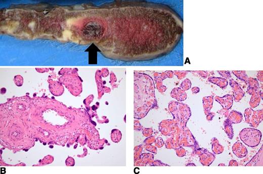 Figure 3. Placental histology in women with pregnancy-associated TTP and following treatment. (A) Pretreatment delivery at 28 weeks’ gestation: placenta showing an infarct (arrow). (B) Pretreatment delivery at 28 weeks’ gestation: distal villous hypoplasia, indicating ischemia (hematoxylin and eosin ×200). (C) Subsequent delivery following treatment at 36 weeks’ gestation: normal villi (hematoxylin and eosin ×200).