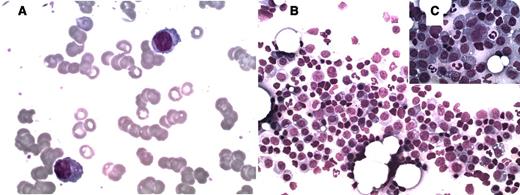 A 51-year-old man who was previously healthy was admitted to the local orthopedics department with lower back pain and weakness of the lower extremities. He presented with leukocytosis of 11 × 109/L and his hemoglobin level was 90 g/L. Complete blood count with automated differential reported >20% large unstained cells. The peripheral smear showed rouleau formation and 23% of circulating plasma cells with atypical features such as a higher nuclear-to-cytoplasmic ratio, dispersed nuclear chromatin, and prominent nucleoli (panel A). A bone marrow aspirate smear demonstrated 70% plasma cell infiltration with cells of either mature or plasmablastic morphology and vacuoles in the cytoplasm (panels B-C). Serum immunofixation revealed production of IgA with λ light-chain restriction. The diagnosis was primary plasma cell leukemia (PCL), which is a rare presentation (4/10 000 000 persons per year) of multiple myeloma (MM). / Primary PCL is characterized by leukocytosis with circulating plasma cells that typically exceed 2000/μL or 20% of the peripheral white blood cell count. The bone marrow infiltration is usually extensive and consists of plasma cells with atypical and immature morphology. Compared with MM, PCL has a poor prognosis, with a median survival of 8 to 12 months.