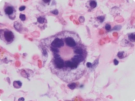 A 28-year-old female presented with chills, sweats, and profound weakness. Laboratory findings revealed hypercalcemia, elevated lactate dehydrogenase, and pancytopenia. Bone marrow aspirate revealed 95% blasts with 2 distinct populations. A subset of blasts (20%) had typical morphology with small- to medium-sized nuclei, relatively regular nuclear outlines, and scant cytoplasm; however, the majority of the blasts were large and atypical with highly convoluted nuclear outlines, numerous cytoplasmic vacuoles, and binucleation/multinucleation with rosette-like features. By flow cytometric analysis, both of the blast populations expressed CD4 (dim), CD13, CD15, CD33 (dim), CD36, CD64 (dim), and MPO (dim) without expression of HLA-DR, CD34, or CD117, findings indicative of acute myeloid leukemia with monocytic differentiation. There was no phenotypic evidence of megakaryocytic differentiation. Genetic studies revealed 5 clonal cell lines with complex cytogenetic abnormalities and FLT-3 D835 point mutation without FLT-3 internal tandem duplication, NPM1, or CEBPA. / The patient underwent induction chemotherapy with CPI-613, cytarabine, and mitoxantrone. The small blasts with conventional morphology showed a good response to induction chemotherapy. However, the atypical large blasts were persistent in subsequent bone marrow biopsies despite repeated courses of chemotherapy, suggesting resistance to conventional treatment. The patient died 9 months after the initial diagnosis without achieving complete remission.