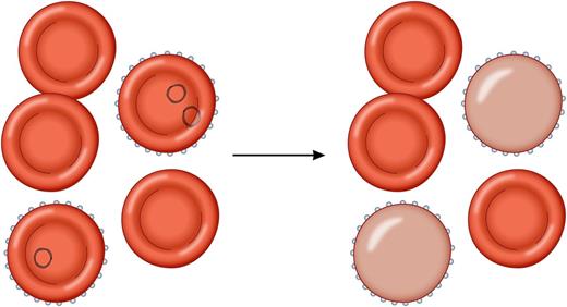 (Left) Malaria-infected erythrocytes. (Right) Parasites killed by artesunate have been removed by the spleen, resulting in a population of once-infected erythrocytes with a considerably decreased life span of about 7 to 21 days. Professional illustration by Patrick Lane, ScEYEnce Studios.