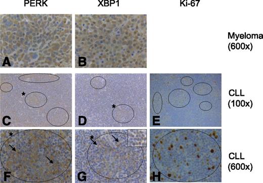 Figure 6. UPR activation in CLL/SLL LNs. Immunohistochemical analysis of expression of (A,C,F) PERK, (B,D,G) XBP1, and (E,H) Ki-67 in (A-B) multiple myeloma and (C-H) CLL/SLL LNs. Original magnification of images are shown. Results are representative of a total of 11 biopsies analyzed. CLL PCs are circled, and higher-magnification images of the PC marked (*) in C and D are shown in F and G. The inset in G shows the nuclear expression of XBP1 in the small CLL cells in contrast to the cytoplasmic expression in the large blasts in the PCs. Arrows highlight large blasts in F and G. Images for C and F (PERK) and D and G (XBP1) are from samples 8 and 11, respectively. Inset shown in G is from sample 1.