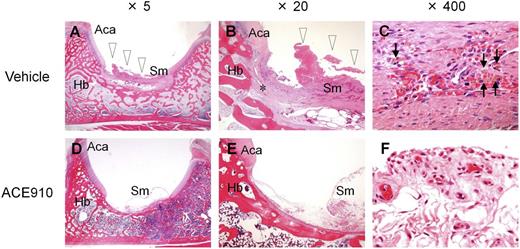 Figure 4. Histopathological findings in a representative joint in a long-term primate model of acquired hemophilia A. Left hip joint with limping in the vehicle #1 monkey (A-C) and left hip joint without limping in the ACE910 #3 monkey (D-F) are shown at original magnification ×5 (A, D), ×20 (B, E), and ×400 (C, F). Hemorrhagic changes (arrowheads) including hemosiderin deposition (arrows) and destruction of articular cartilage/underlying bone (*) are detected in the joint with limping (A-C). No hemorrhagic changes are noted in the joint without limping (D-F). Hematoxylin and eosin stain. Aca, articular cartilage of acetabulum; Hb, hip bone; Sm, synovial membrane.