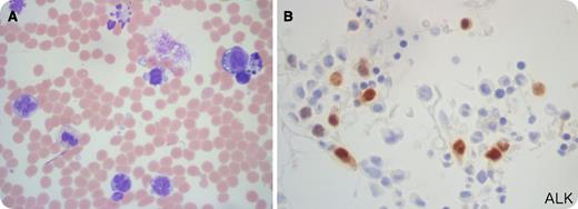 This peripheral blood (PB) smear from a 24-year-old man with retroperitoneal lymphadenopathy and a white blood cell count of 77 × 109 cells/L (66% lymphocytes) showed variably-sized atypical lymphocytes with irregular nuclear contours and basophilic vacuolated cytoplasm including numerous flower cells and apoptotic cells (panel A). Hallmark cells with reniform nuclei, small to large in size, were a minor proportion (panels A and B). Flow cytometric analysis (FC) of the PB and bone marrow (BM) samples detected a T-cell population with low forward scatter and CD2+(dim), CD3+(dim), CD7+, CD8+(dim), CD4–, CD5–, and CD25+; CD30 expression was dim in the BM and negative in the PB by FC. BM morphology showed scattered interstitial infiltration of small- to medium-sized atypical lymphocytes that were variably CD30+ and ALK+ (nuclear staining) by immunohistochemistry (panel B). BM fluorescence in situ hybridization and karyotype studies revealed ALK rearrangement and t(2;5)(p23;q35), respectively. / Strong uniform CD30 expression, typical of the common variant, was not observed in these samples. Furthermore, the flower cells seen raise the possibility of adult T-cell leukemia/lymphoma. This case highlights the broad morphologic spectrum of ALK+ ALCL and underscores the importance of a multimodal diagnostic approach in T-cell lymphoma that includes investigation of ALK rearrangement and/or staining, defining features of this entity.
